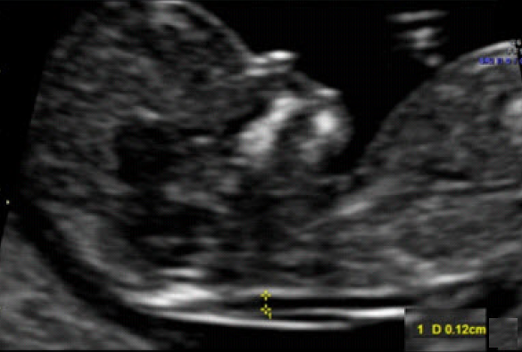 Abdominal ultrasound at 8w3d? - Plus Size Moms and Moms to Be | Forums |  What to Expect